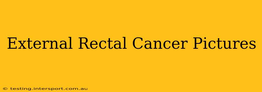External Rectal Cancer Pictures